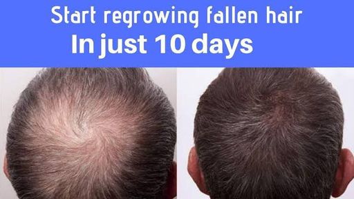 Stop Hair Fall &Regrow 
