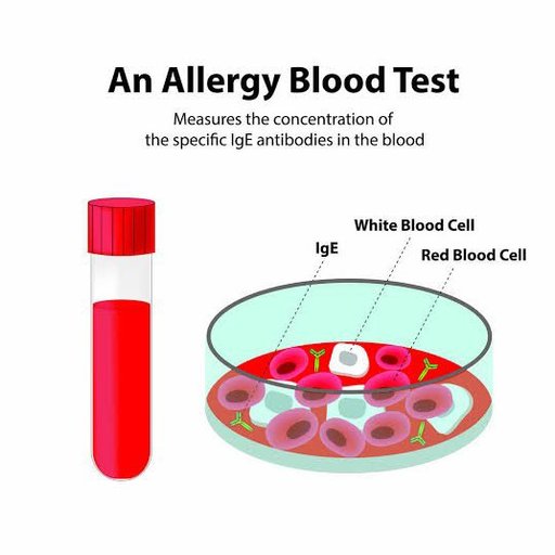 Serum IgE (Allergy Test)
